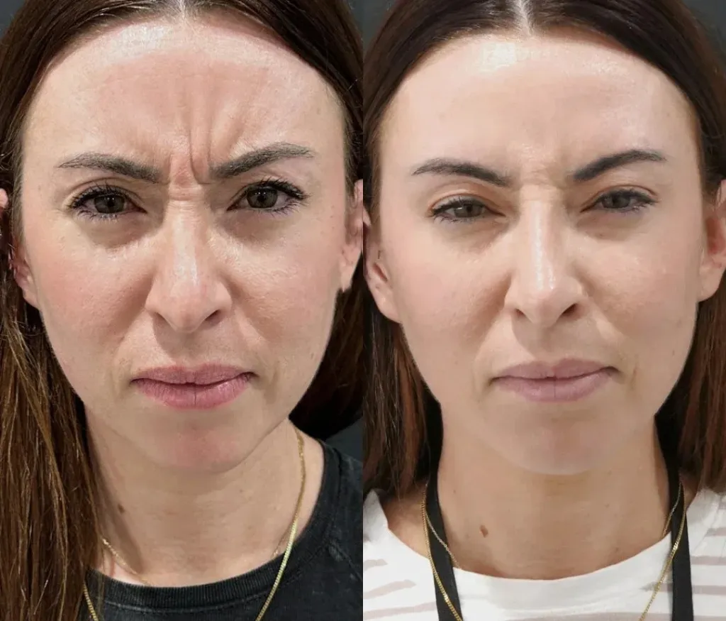 Camila Antes e Depois